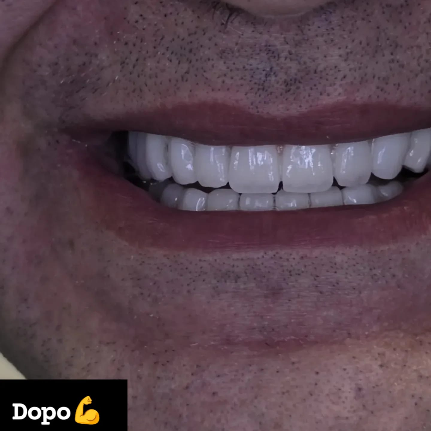 Dopo il trattamento dentale